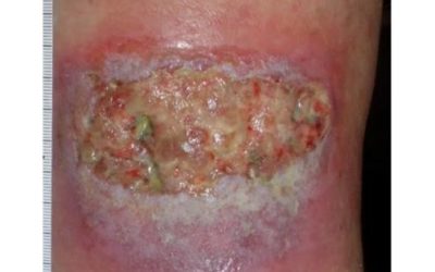 The Many Faces of Pyoderma Grangrenosum – a Leg Ulcer Present for a Year