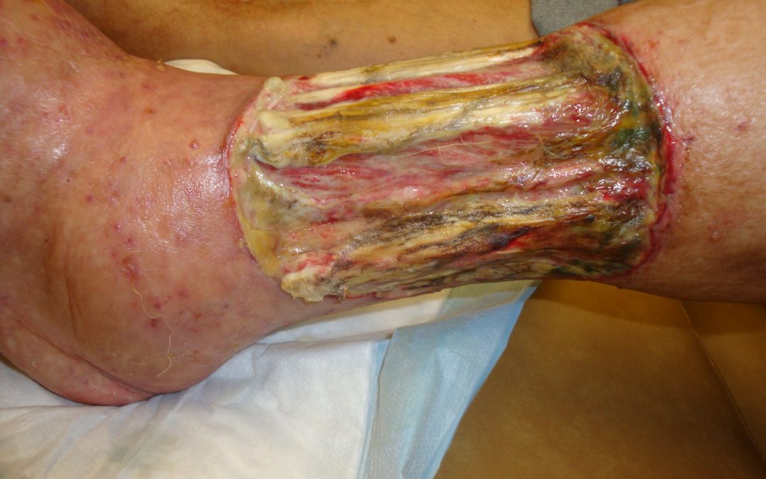 Amputations in Pyoderma Gangrenosum Patients: Underreported or Very Rare? | Today’s Wound Clinic