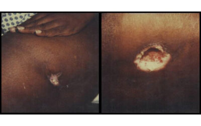 Erythema Nodosum, Tuberculosis and the Vital Importance of Asking Ourselves “Why?”