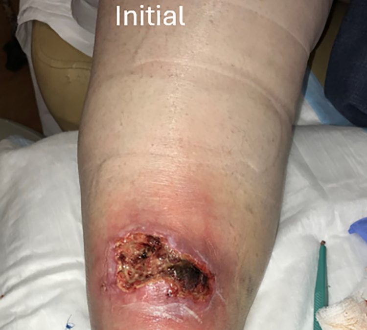 The Power of Edema Management to Heal Even Non-Venous Ulcers