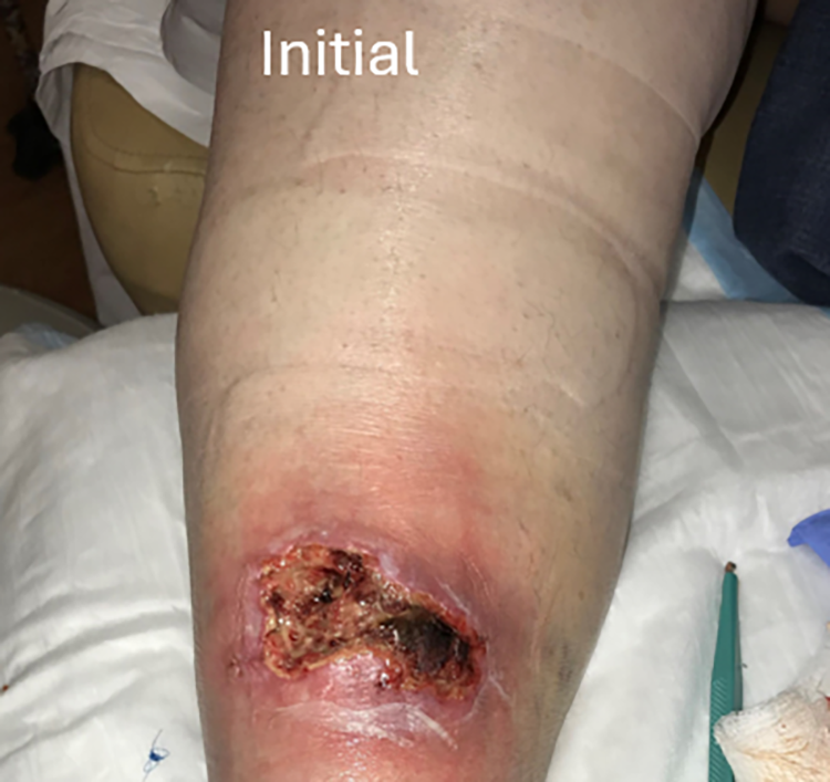 The power of edema management to heal even non-venous ulcers