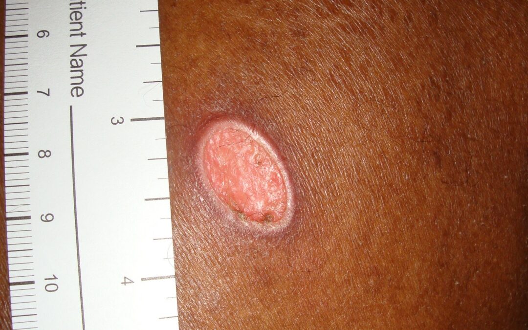 A Long Ago Case of Cutaneous Cryptococcus – That Looked Like No Big Deal