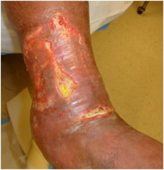 Transformational Ideas in Wound Healing & Lymphedema: Compression Dressings – Unwrapped!  Guest Blog by Robert Goldman MD