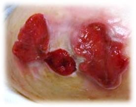 Not Every Peristomal Ulceration is PG – Check Out This Case Report in JAMA Dermatology