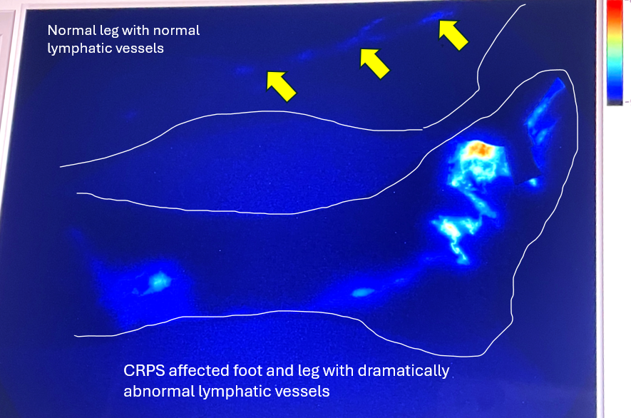 New Evidence Suggests that Lymphatic Dysfunction May be Linked to Chronic Regional Pain Syndrome (CRPS) – Guest Blog by Davis Melin and Mark Melin