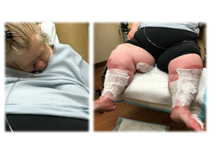 Wound Care Practitioners Should Screen Patients for Sleep Apnea- Here’s How!